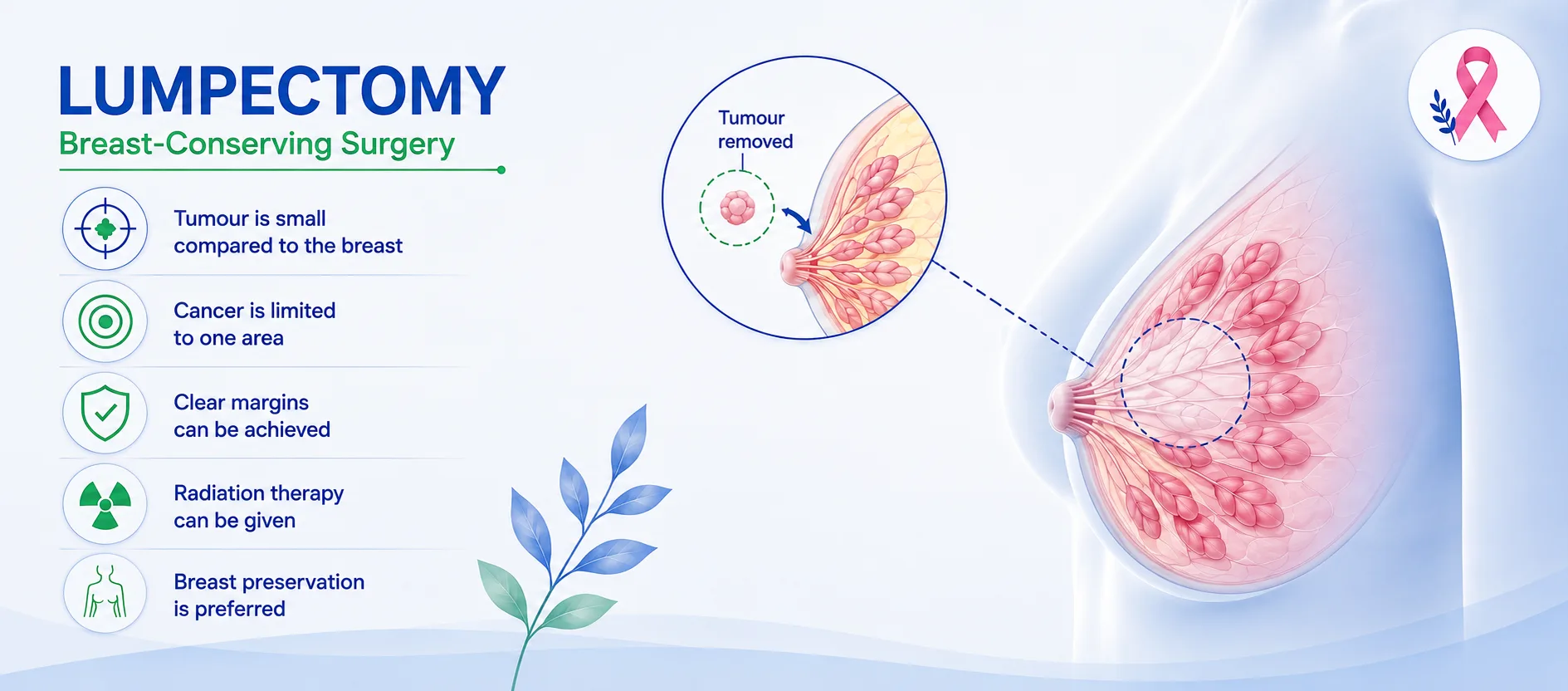 Infographic titled 'Lumpectomy: Breast-Conserving Surgery' showing a diagram of a breast with the tumour removed, alongside five key points: tumour is small compared to the breast, cancer is limited to one area, clear margins can be achieved, radiation therapy can be given, and breast preservation is preferred