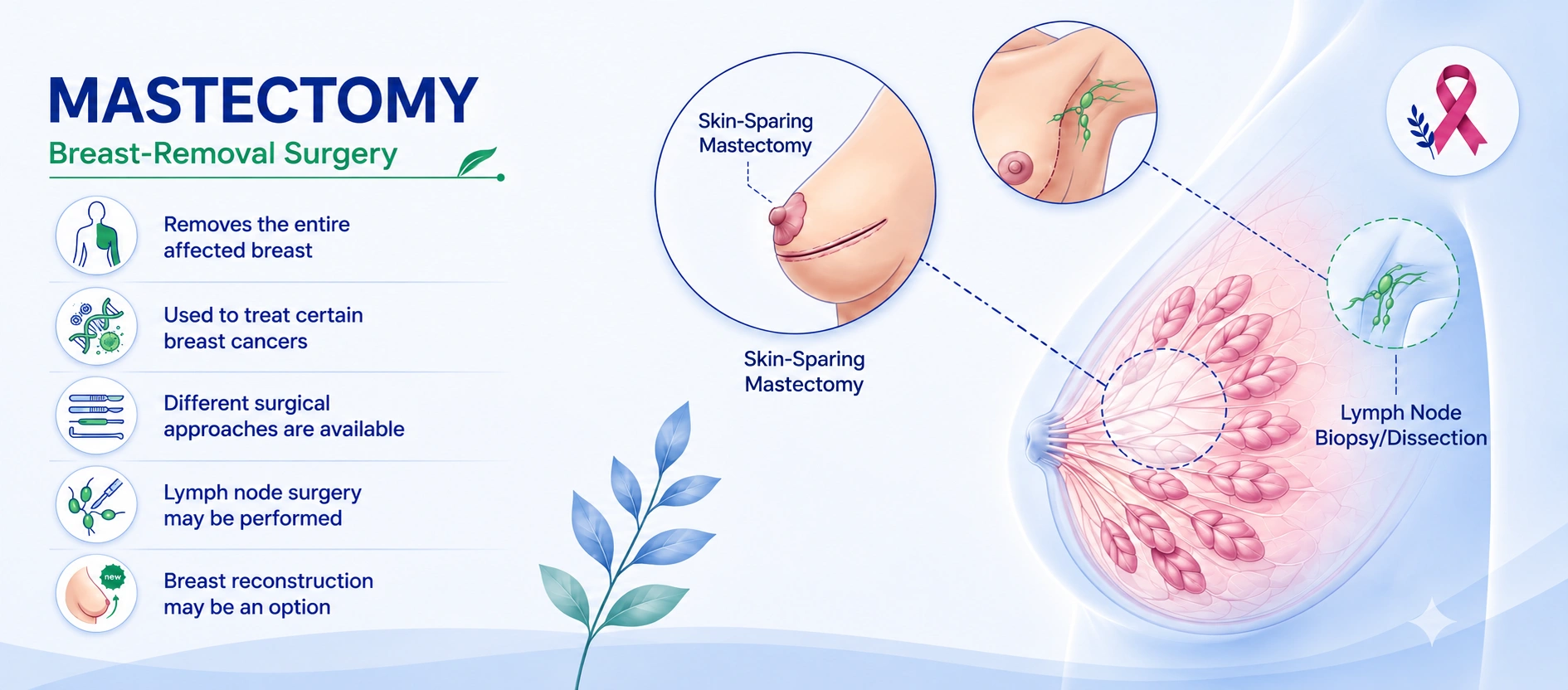Infographic titled 'Mastectomy: Breast-Removal Surgery' showing diagrams of skin-sparing mastectomy and lymph node biopsy/dissection, alongside five key points: removes the entire affected breast, used to treat certain breast cancers, different surgical approaches are available, lymph node surgery may be performed, and breast reconstruction may be an option.