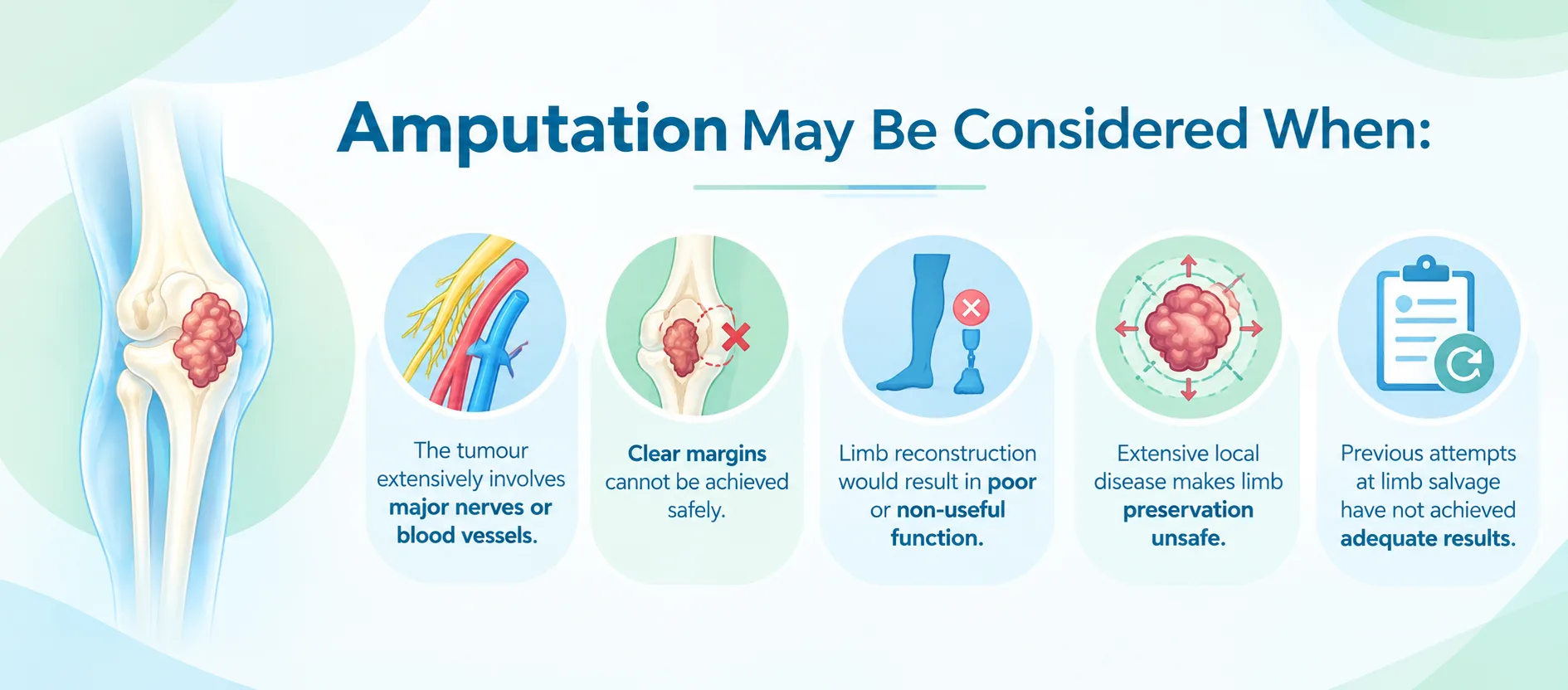 Infographic by Dr. Pushpinder Gulia explaining when amputation may be considered for bone sarcoma, including major nerve or vessel involvement, inability to achieve clear margins, poor limb function outcomes, extensive local disease, and failed limb salvage attempts